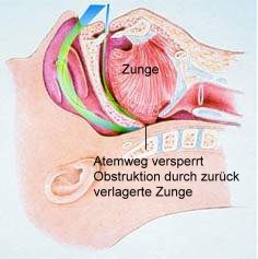 Schnarcher-Atmung